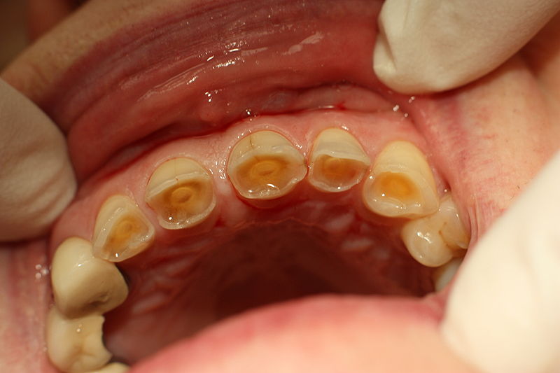 Wear & Tear of Teeth? What's That? GetDoc