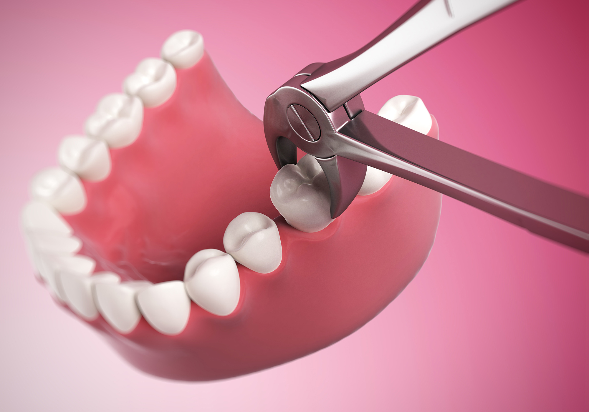 tooth extraction