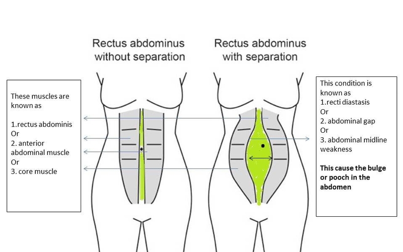 Rectus Diastasis