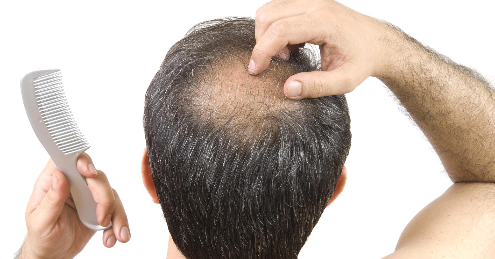 hair loss dr inder