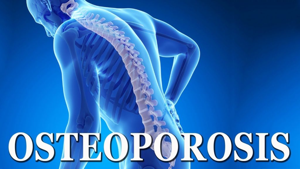 What Is Osteoporosis? GetDoc Says