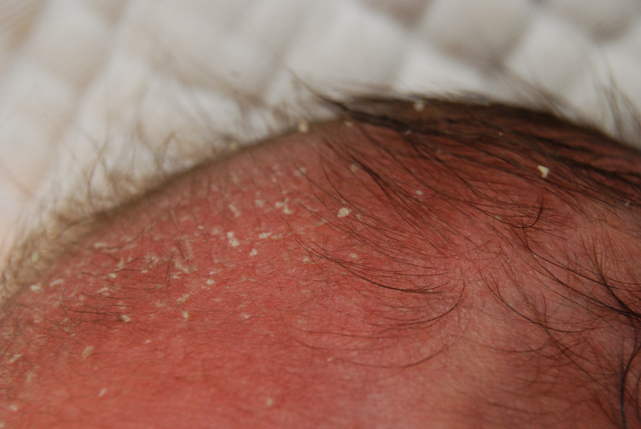 Blisters During Infancy How To Handle Them GetDoc Says