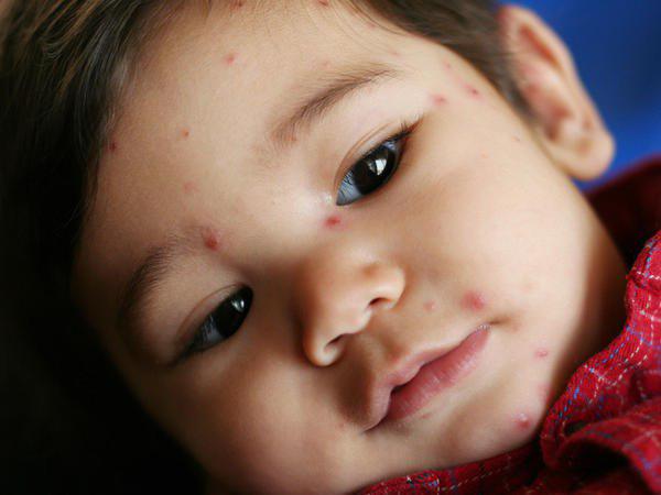 infections in children