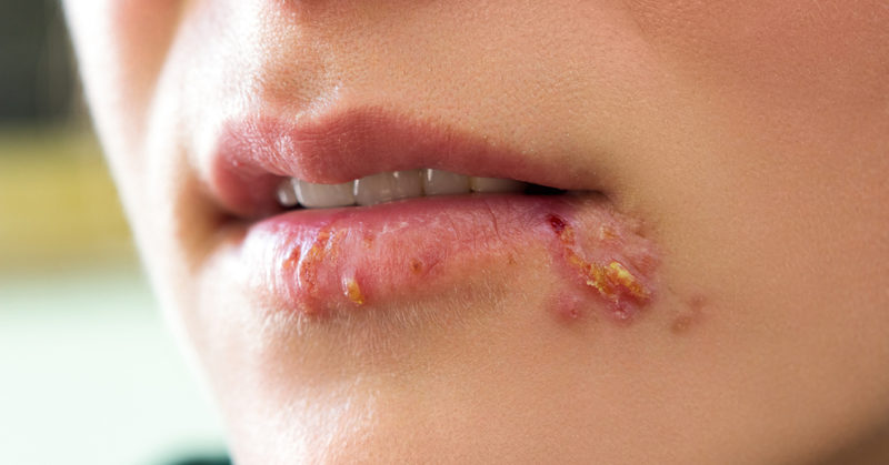 cold sore