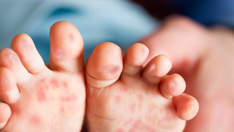 hand foot and mouth disease