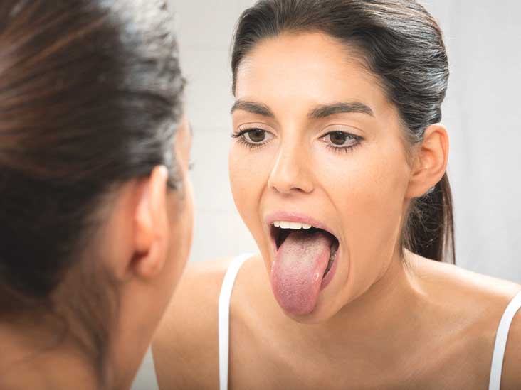 oral thrush