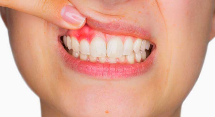 Gum disease causing swollen and bleeding gums