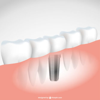 dental implant