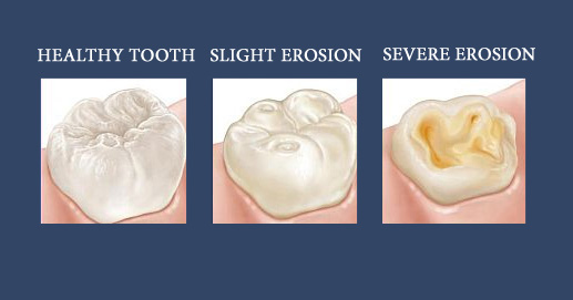 Tooth Erosion: What You Eat or Drink Can Damage Your Teeth
