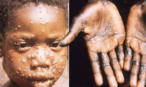 Monkeypox / Monkeypox virus: What is Monkeypox? How many UK cases of