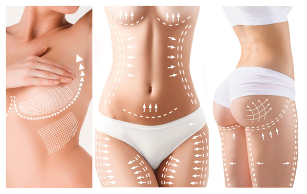 Liposuction explained