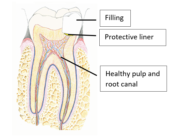 Vital Pulp Therapy Saving Teeth One Pulp At A Time!