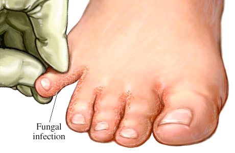 Althlete's foot and fungal infection