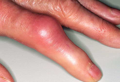 gout