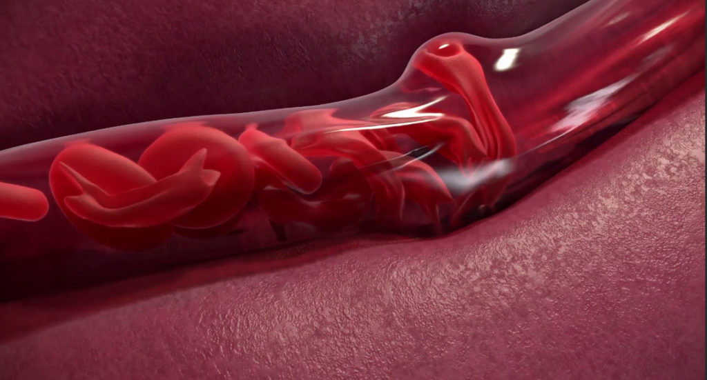 How One Child's Sickle Cell Mutation Saved The Lives Of Many 