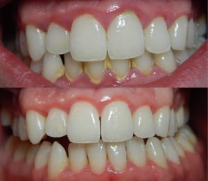 Before and after dental scale and polish