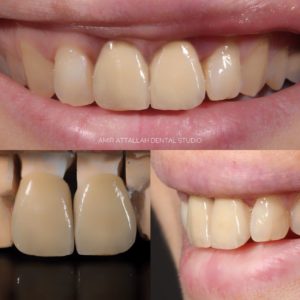 Dental crown made from porcelain
