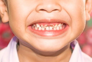 Early Childhood Caries