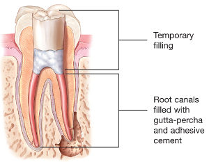 Root canal filling 