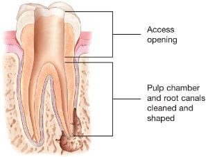 Root canal treatment stage 1