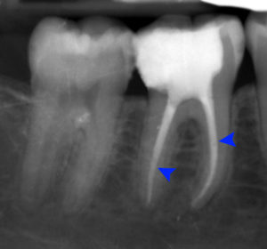Radiograph of a root canal treatment 