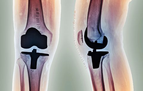 joint replacement surgery orthopaedic surgeon knee