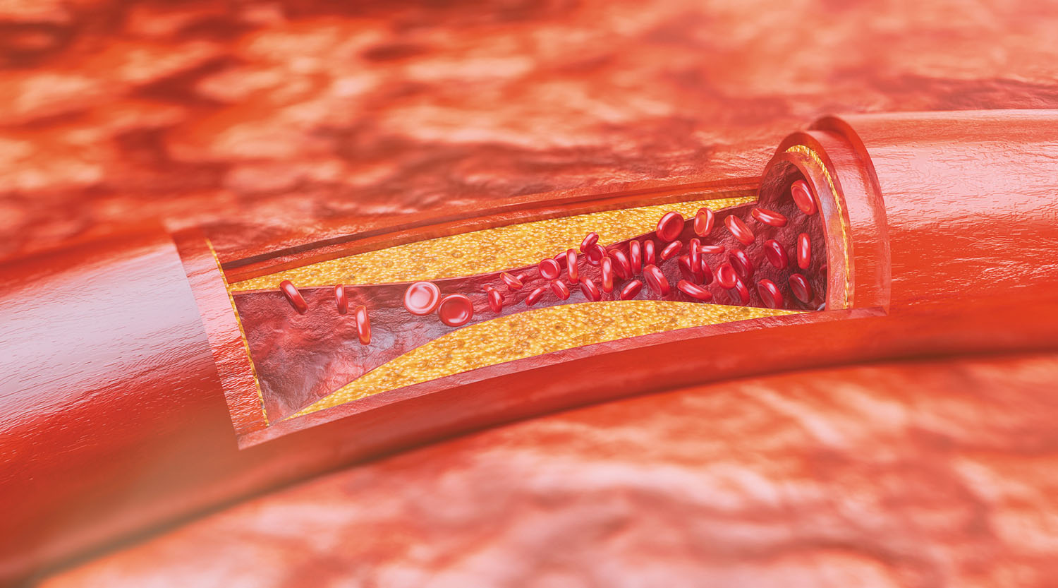 On Cholesterol : The Good & The Bad
