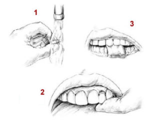 Knocked out tooth 