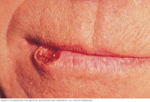 Oral cancer on lower lip