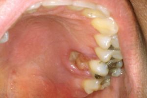 Oral cancer on palate 