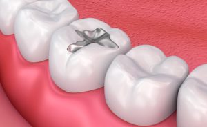 dental amalgam filling