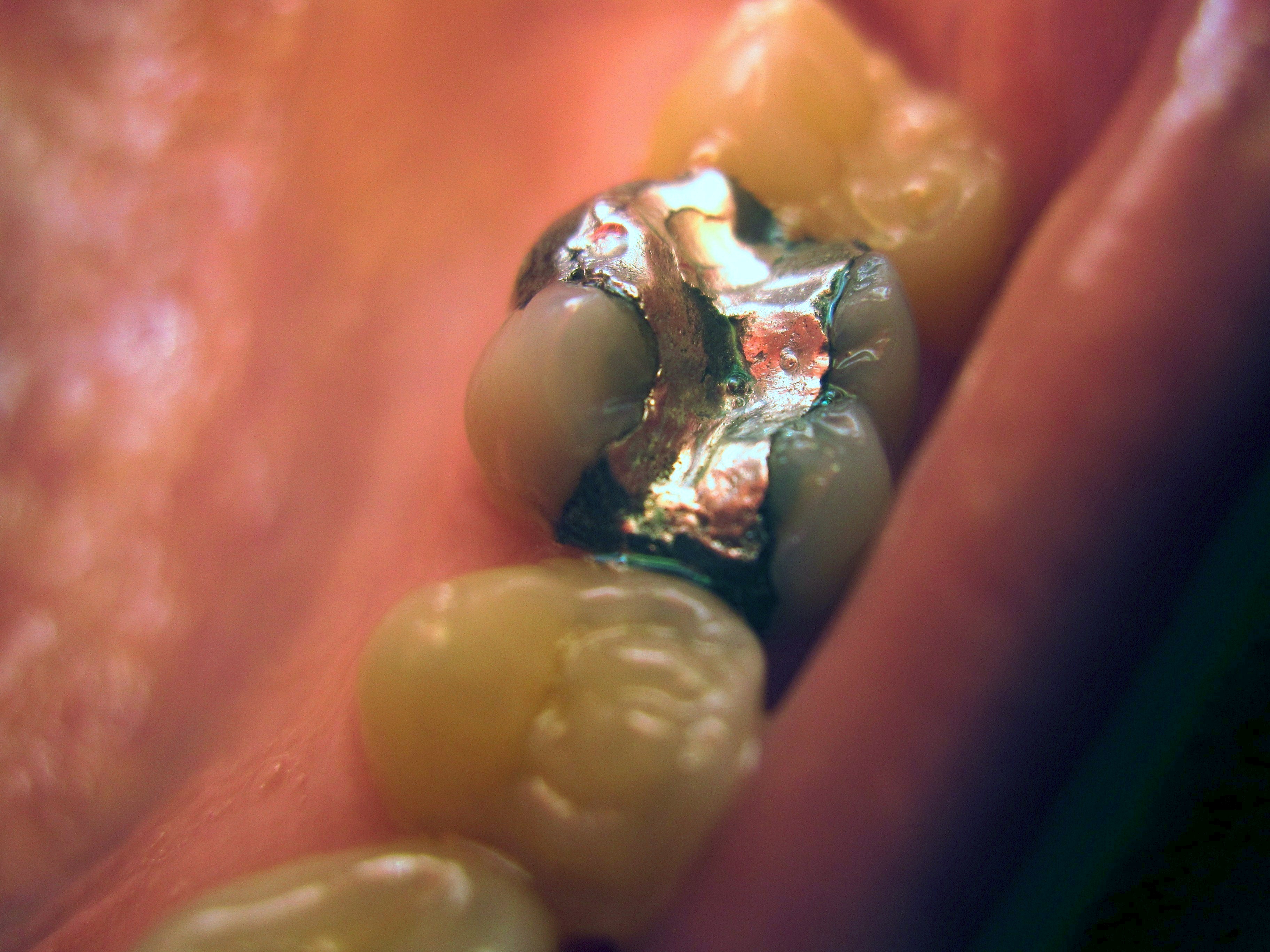 Dental amalgam filling