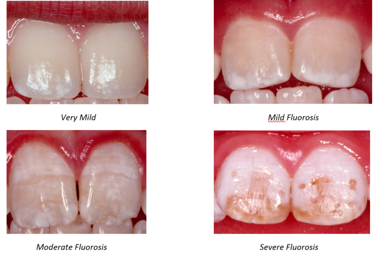 White Spots and Lines What’s that lurking on My Teeth?