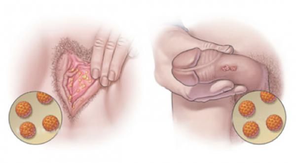 HPV Infection hpv infection