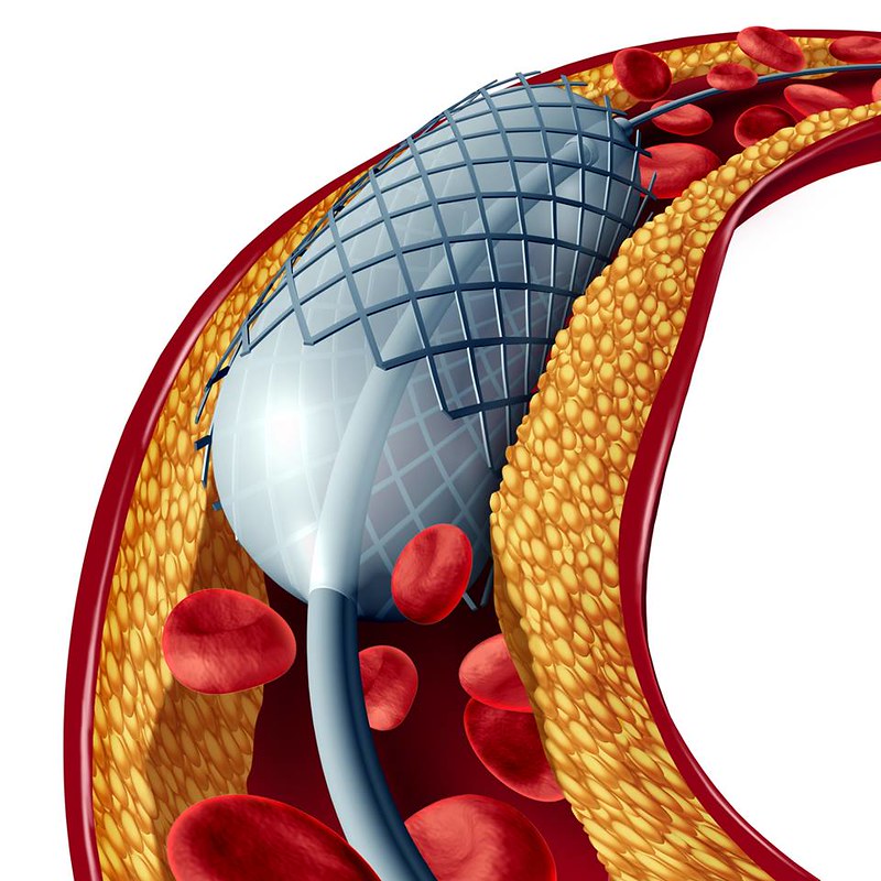 heart stent, angioplasty, balloon catetherisation, heart attack
