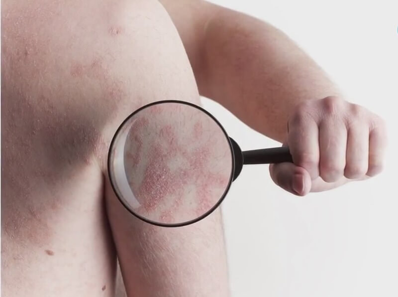 shingles zoster herpes varicella heart disease