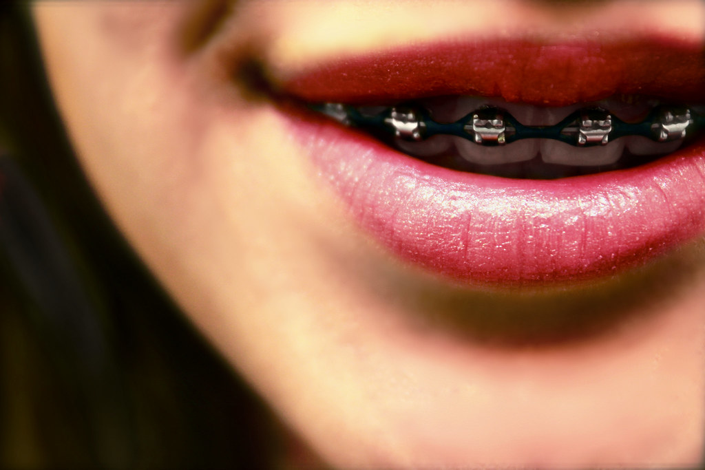 braces and oral hygiene