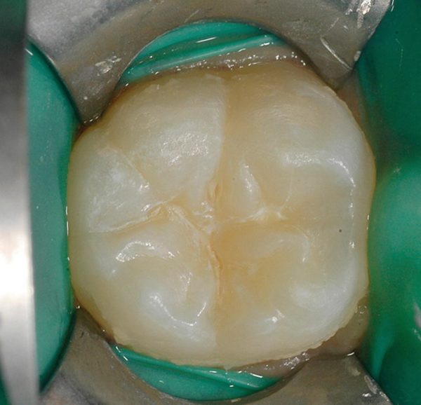 Dental Sealants Sealing Your Teeth From Tooth Decay