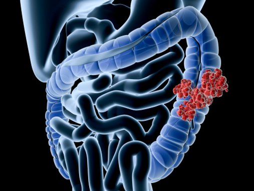 colon cancer colorectal prevention screening symptoms